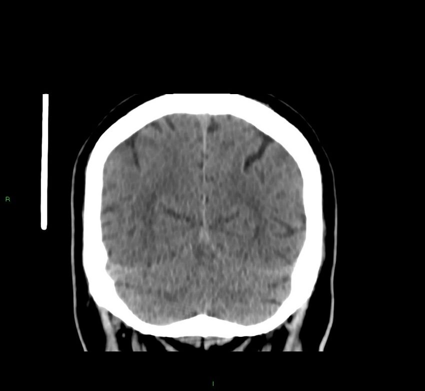 Brainstem hemorrhage (Radiopaedia 58794-66028 Coronal non-contrast 17).jpg