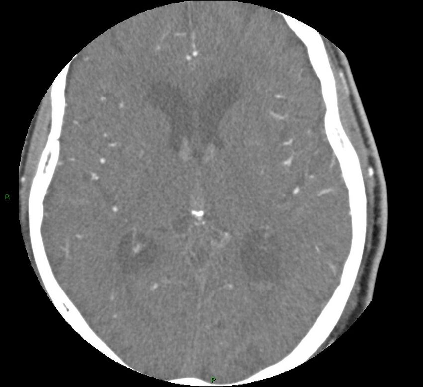 Brainstem hemorrhage (Radiopaedia 58794-66028 D 101).jpg
