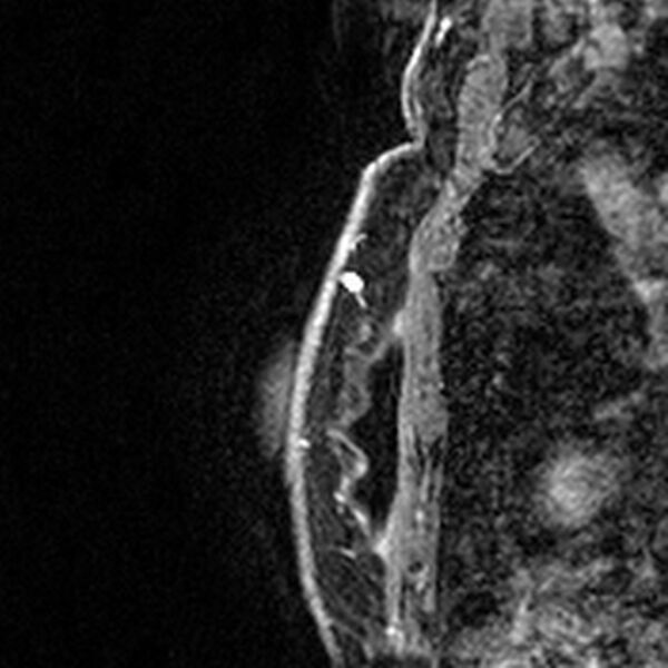 File:Breast implants - MRI (Radiopaedia 26864-27035 Sagittal T2 81).jpg
