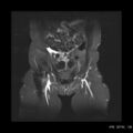 Broad ligament fibroid (Radiopaedia 49135-54241 Coronal STIR 5).jpg