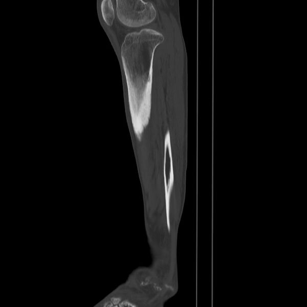 File:Brodie abscess - tibia (Radiopaedia 66028-75204 Sagittal bone window 53).jpg