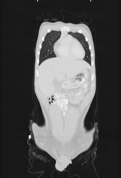 File:Bronchial carcinoid tumor (Radiopaedia 57187-64090 Coronal lung window 15).jpg