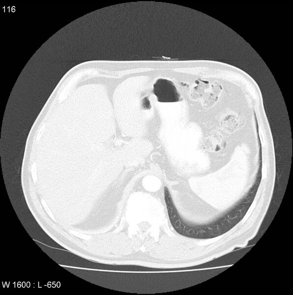 File:Bronchial carcinoid tumor with right lower lobe collapse (Radiopaedia 29060-29422 B 54).jpg