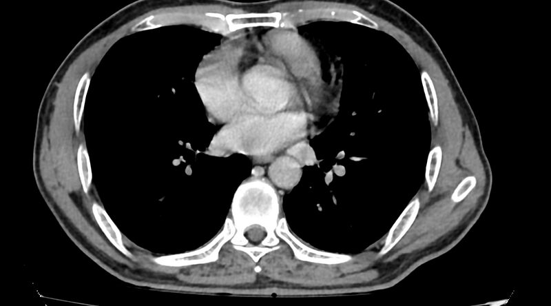 File:Bronchogenic carcinoma with superior vena cava syndrome (Radiopaedia 36497-38054 Axial C+ delayed 61).jpg