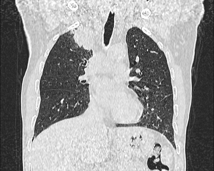 Bronchogenic carcinoma with superior vena cava syndrome (Radiopaedia 36497-38054 Coronal lung window 27).jpg
