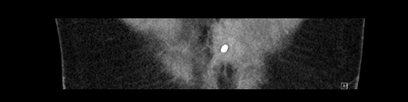 File:Buried bumper syndrome - gastrostomy tube (Radiopaedia 63843-72575 Coronal Inject 20).jpg