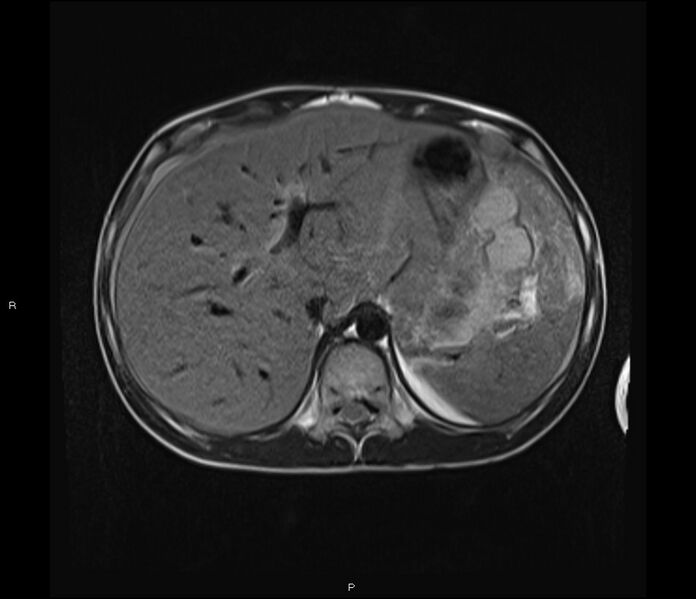 File:Burkitt lymphoma (bowel) (Radiopaedia 68839-78557 Axial T2 13).jpg