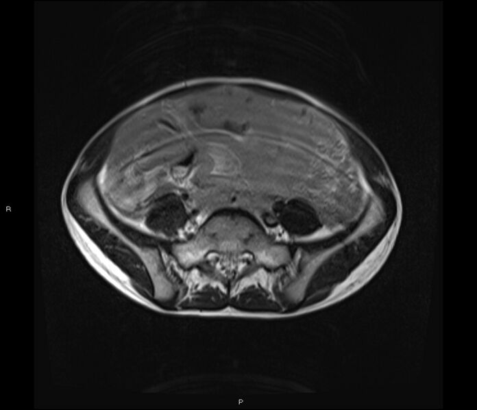 File:Burkitt lymphoma (bowel) (Radiopaedia 68839-78557 Axial T2 45).jpg