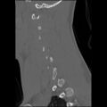C5 facet fracture (Radiopaedia 58374-65499 Sagittal bone window 51).jpg