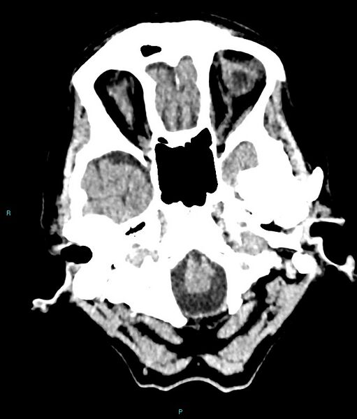File:Calcified cerebral emboli from left ventricular thrombus (Radiopaedia 84420-99758 Axial non-contrast 79).jpg