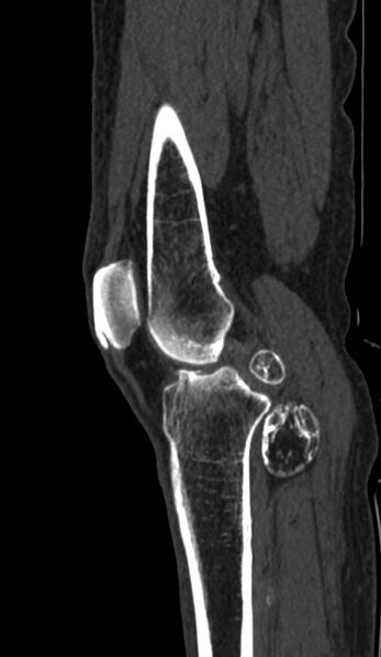 File:Calcified hematoma - popliteal fossa (Radiopaedia 63938-72763 Sagittal bone window 27).jpg