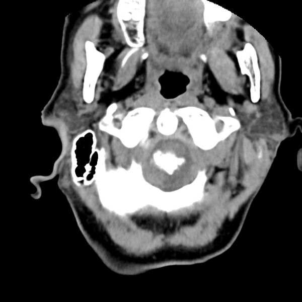 File:Calcified meningioma - cervical canal (Radiopaedia 70136-80171 B 4).jpg