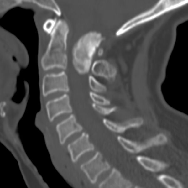 File:Calcified meningioma - cervical canal (Radiopaedia 70136-80171 Sagittal bone window 17).jpg