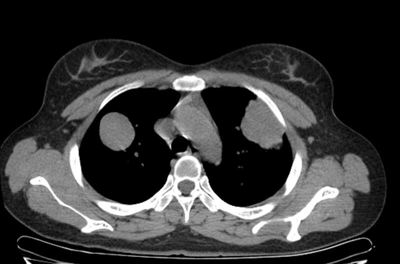 File:Cannonball metastases - uterine choriocarcinoma (Radiopaedia 70137-80173 Axial non-contrast 24).jpg