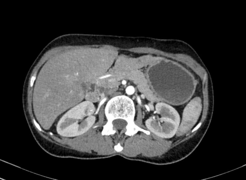File:Cannonball metastases from breast cancer (Radiopaedia 91024-108569 A 133).jpg