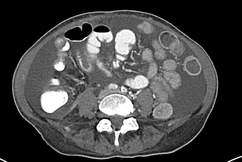 File:Carcinoid mesenteric tumor complicated by chylous ascites (Radiopaedia 76312-87953 A 46).jpg