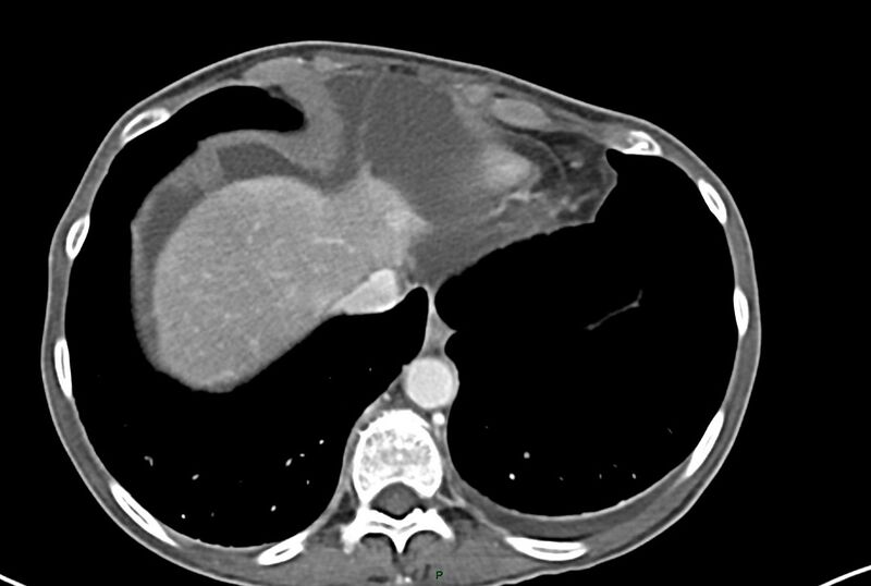 File:Carcinoid mesenteric tumor complicated by chylous ascites (Radiopaedia 76312-87953 A 5).jpg