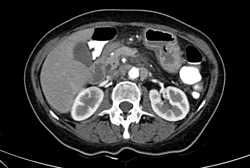 Carcinoid mesenteric tumor complicated by chylous ascites (Radiopaedia 76312-88926 A 26).jpg