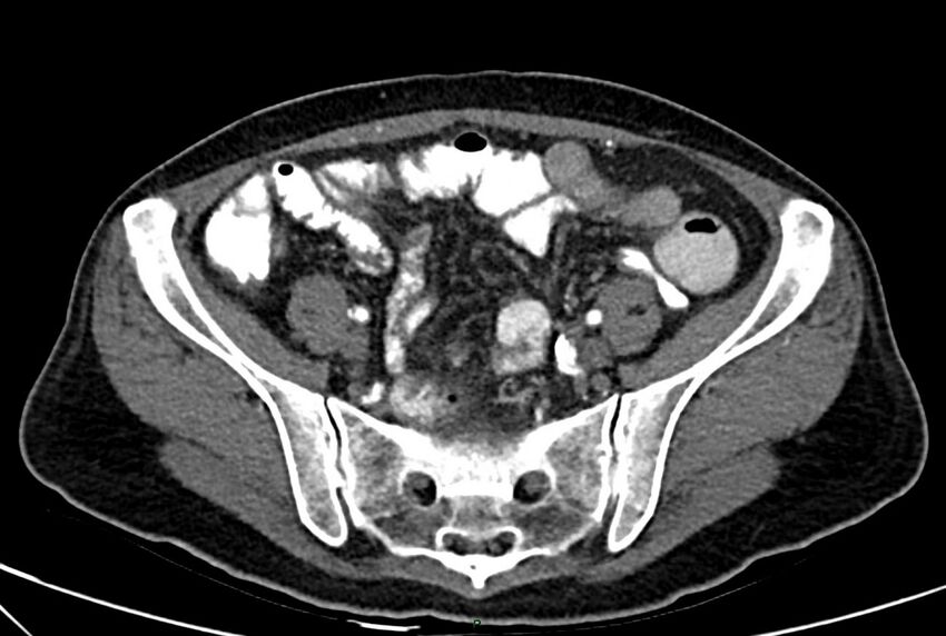 Carcinoid mesenteric tumor complicated by chylous ascites (Radiopaedia 76312-88926 A 55).jpg