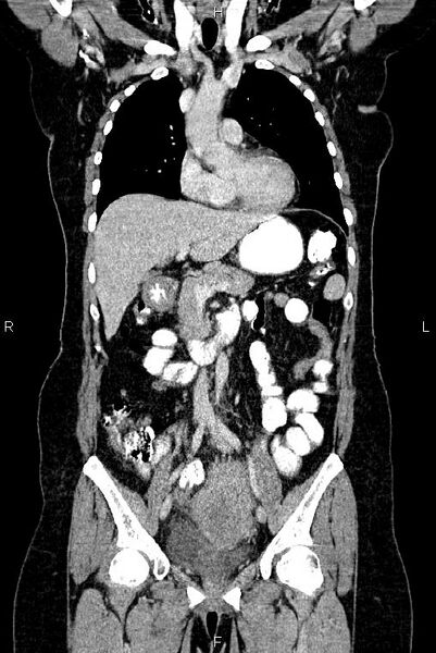 File:Carcinoma of uterine cervix (Radiopaedia 85861-101700 C 22).jpg