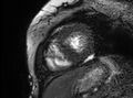 Cardiac amyloidosis (Radiopaedia 61600-69579 Short axis bSSFP 81).jpg