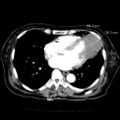 Cardiac fibroma (Radiopaedia 38974-41149 A 7).jpg