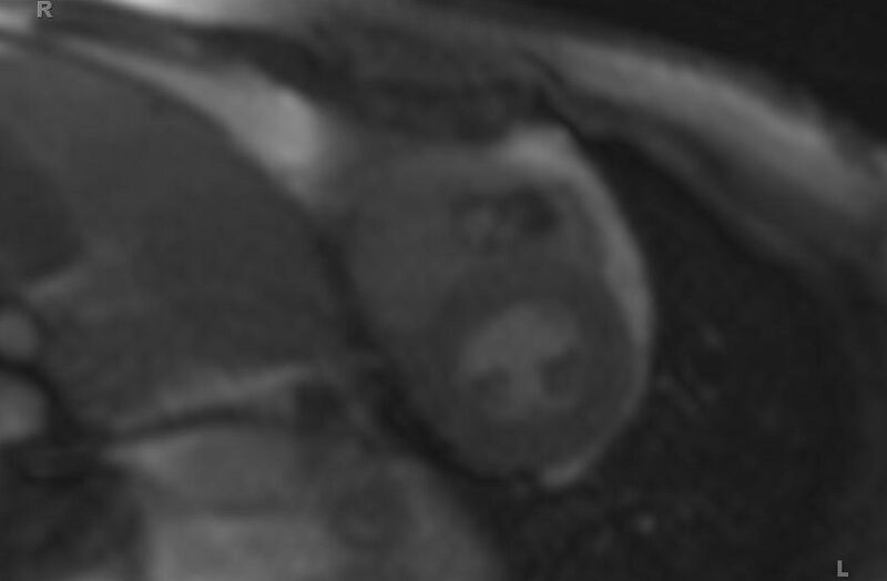 File:Cardiac hemangioma (Radiopaedia 31709-32631 E 45).jpg