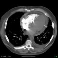 Cardiac tamponade (Radiopaedia 20909-20841 B 1).jpg
