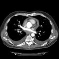 Cardiac tamponade (Radiopaedia 78607-91368 Axial C+ CTPA 47).jpg