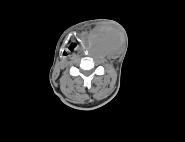 File:Carotid artery pseudoaneurysm (Radiopaedia 84030-99259 Axial non-contrast 27).jpg