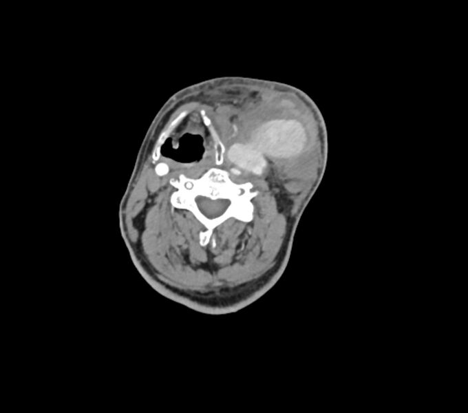File:Carotid artery pseudoaneurysm (Radiopaedia 84030-99259 C 43).jpg