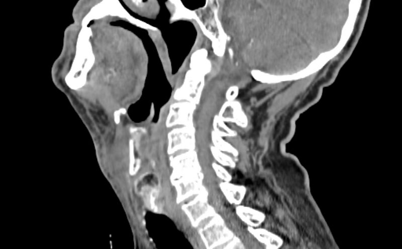 File:Carotid artery pseudoaneurysm (Radiopaedia 84030-99259 E 5).jpg