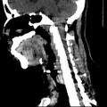 Carotid body tumor (Radiopaedia 27890-28124 C 12).jpg