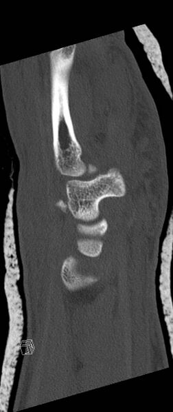 File:Carpal fractures (smart watch impaction) (Radiopaedia 55844-62430 Sagittal bone window 14).jpg