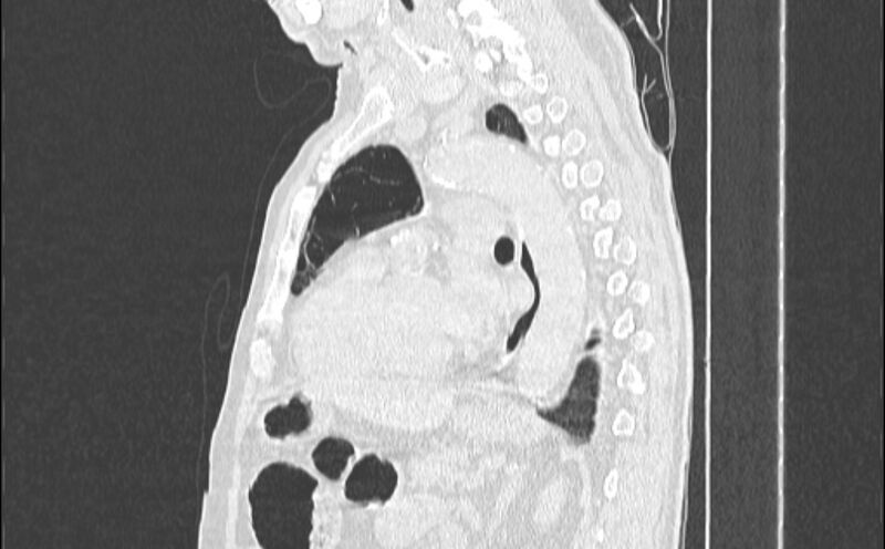 File:Cavitating bronchogenic carcinoma (Radiopaedia 44489-48162 Sagittal lung window 38).jpg
