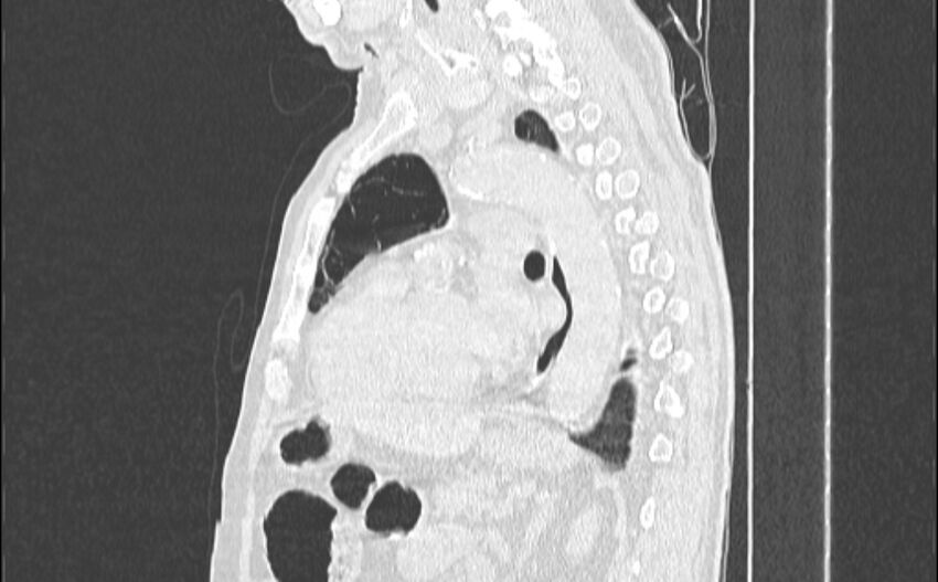 Cavitating bronchogenic carcinoma (Radiopaedia 44489-48162 Sagittal lung window 38).jpg