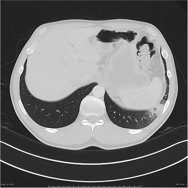 File:Cavitating lung cancer (Radiopaedia 25796-25945 Axial lung window 55).jpg