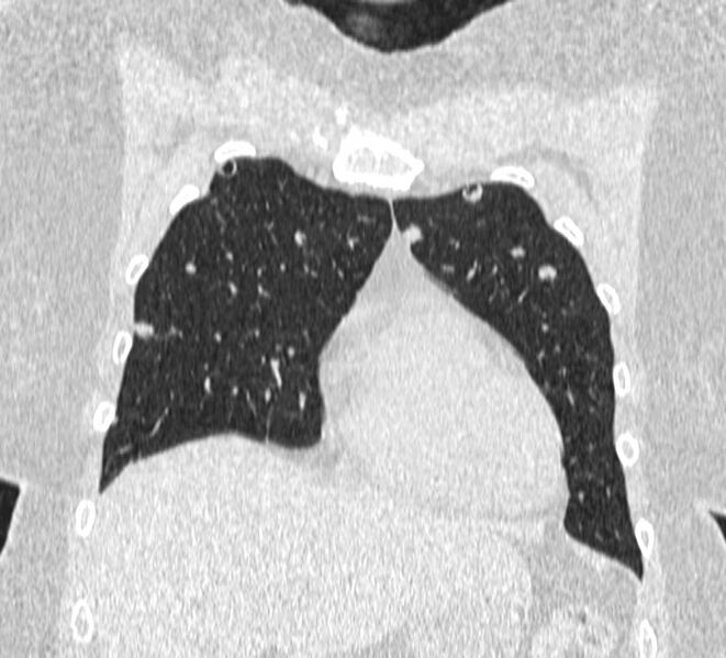 File:Cavitating pulmonary metastases (Radiopaedia 17796-17555 Coronal lung window 2).jpg