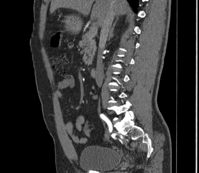 File:Celiac artery dissection (Radiopaedia 52194-58080 B 20).jpg