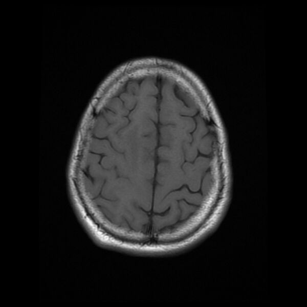 File:Central neurocytoma (Radiopaedia 67618-77021 Axial T1 21).jpg