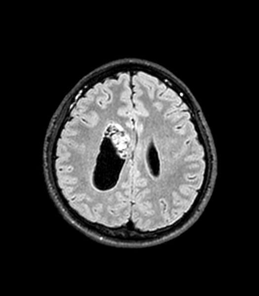 File:Central neurocytoma (Radiopaedia 79320-92380 Axial FLAIR 106).jpg