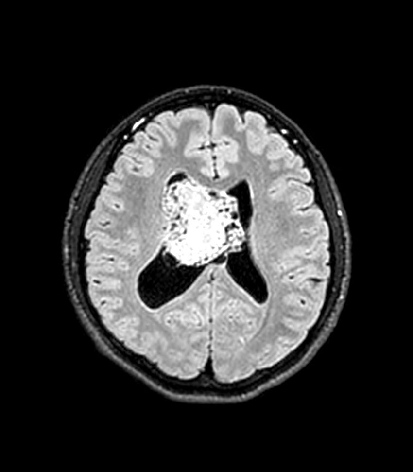Central neurocytoma (Radiopaedia 79320-92380 Axial FLAIR 128).jpg