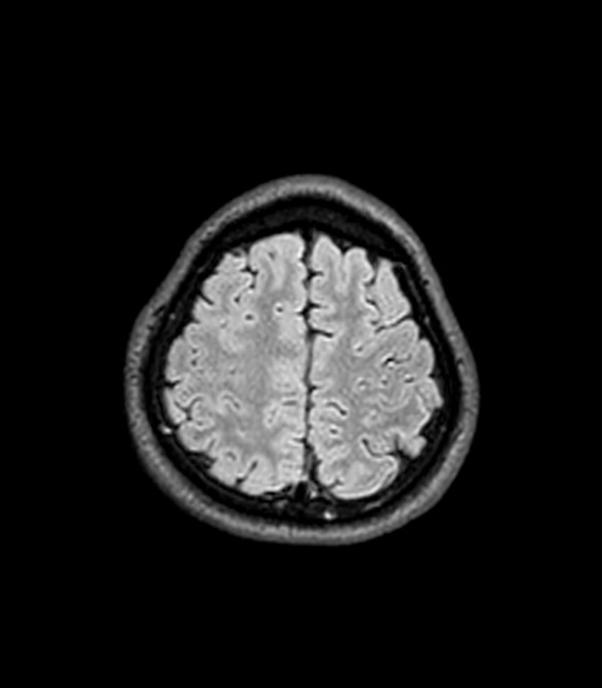 Central neurocytoma (Radiopaedia 79320-92380 Axial FLAIR 68).jpg