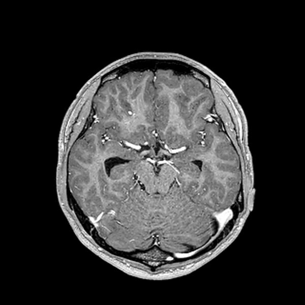 File:Central neurocytoma (Radiopaedia 79320-92380 Axial T1 C+ 101).jpg