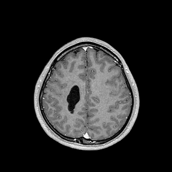 File:Central neurocytoma (Radiopaedia 79320-92380 Axial T1 C+ 176).jpg