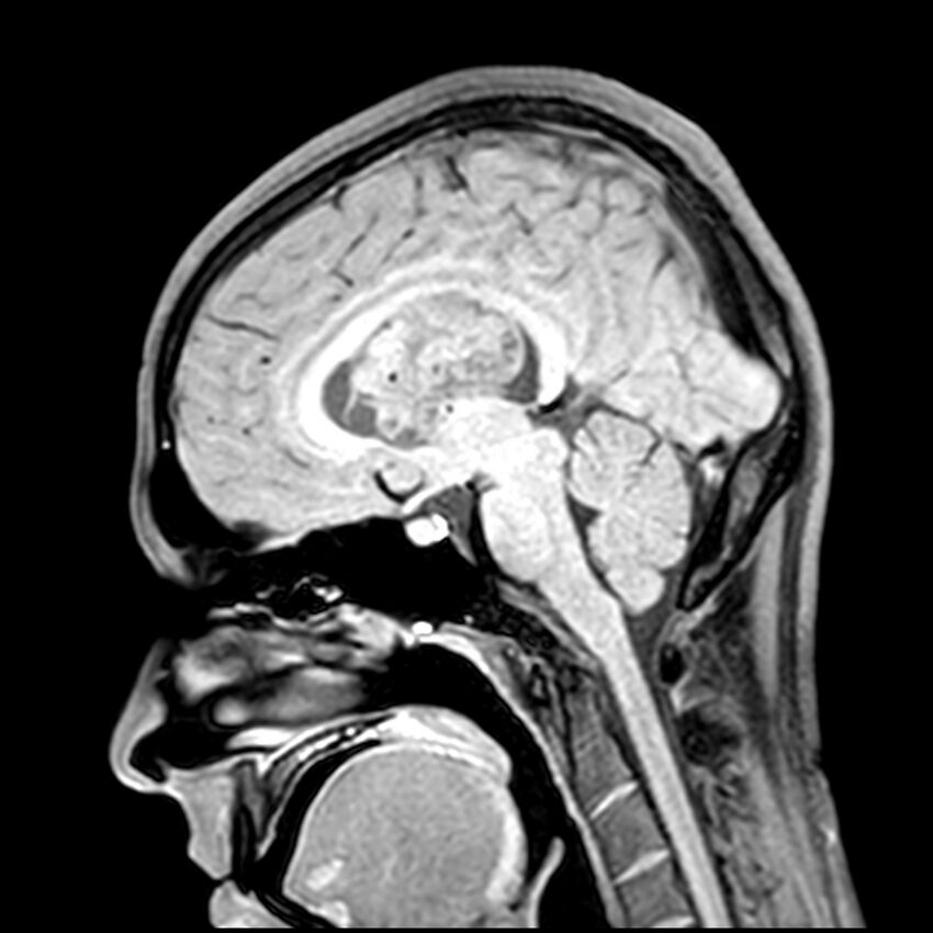Central neurocytoma (Radiopaedia 79320-92380 Sagittal T1 135).jpg