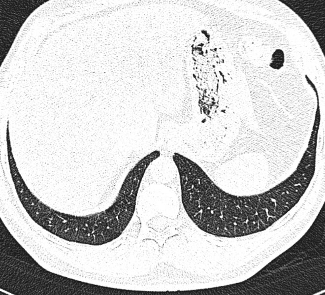 File:Centrilobular pulmonary emphysema (Radiopaedia 26808-26971 Axial lung window 35).jpg