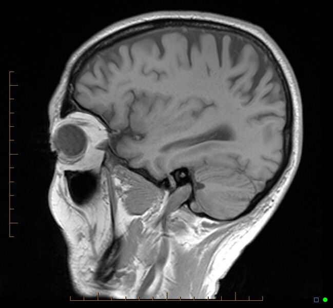 File:Cerebellar gangliocytoma (Radiopaedia 65377-74422 Sagittal T1 11).jpg