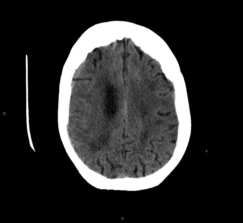 Cerebellar hemorrhage (Radiopaedia 58792-66026 Axial non-contrast 16).jpg