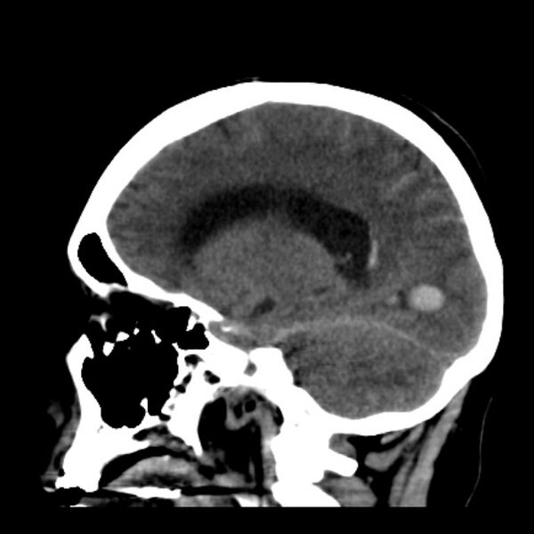 File:Cerebellar hemorrhage causing obstructive hydrocephalus (Radiopaedia 33989-35207 B 30).jpg